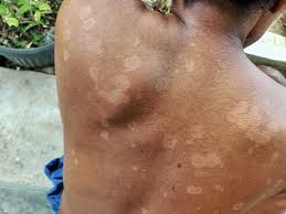 Pityriasis Alba